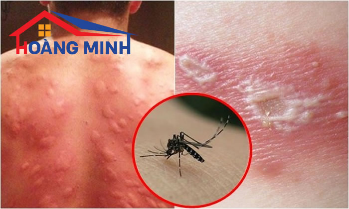 Muỗi đốt để lại nhiều hậu quả nghiêm 
trọng thậm chí nguy hiểm đến tính mạng