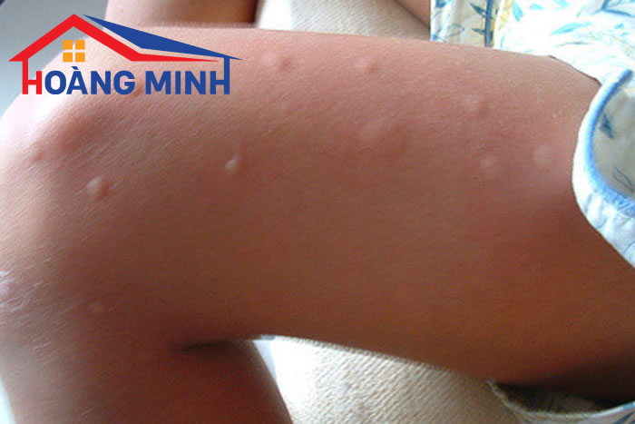 Muỗi đốt khiến trẻ bị mẩn ngứa